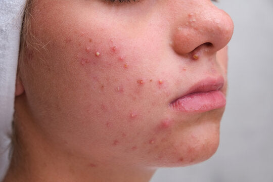 THE DERMA CO. SALICYLIC ANTI ACNE COMBO
