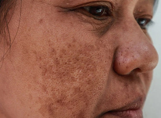 THE DERMA CO. TRAN-ZELIAC COMBO FOR PIGMENTATION