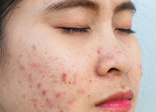 THE DERMA CO. ANTI ACNE SALI-CINAMIDE COMBO