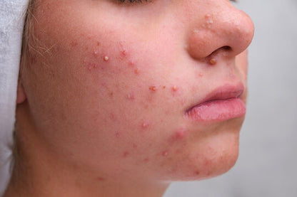 THE DERMA CO. SALICYLIC ANTI ACNE COMBO